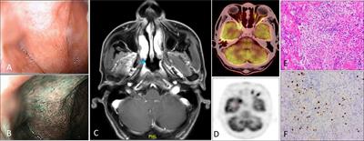 IgG4-related disease with nasopharyngeal malignancy-like manifestations